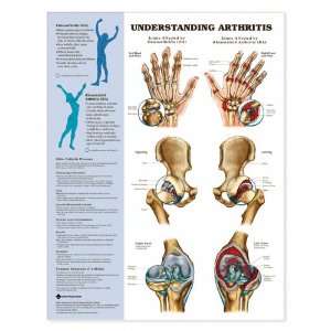  Understanding Arthritis Anatomical Chart Unmounted 9803PU 